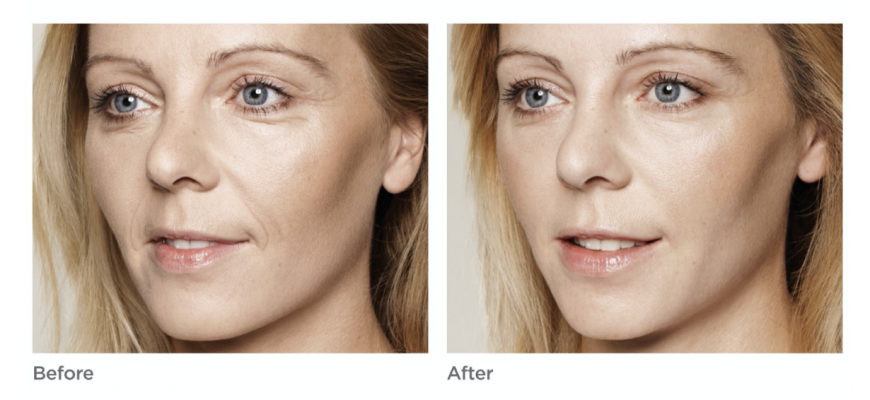 What Are Skin Boosters in Dubai and How Does it Benefit Your Skin? What Are Skin Boosters in Dubai and How Does it Benefit Your Skin?